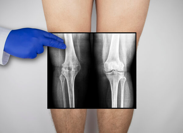 X-ray of a man's knee caps and parts of the leg bones. The radiologist examines the X-ray as part of osteoarthritis management and assessment. » HCi